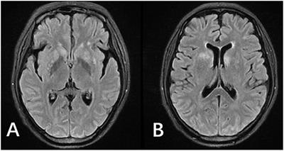 Immune Reconstitution Inflammatory Syndrome Secondary to Autoimmune <mark class="highlighted">Hemolytic Anemia</mark> and Cryptococcal Meningitis